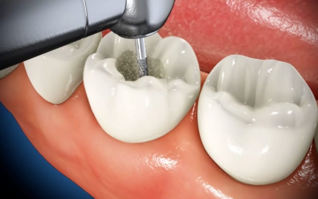 Root Canal Treatment