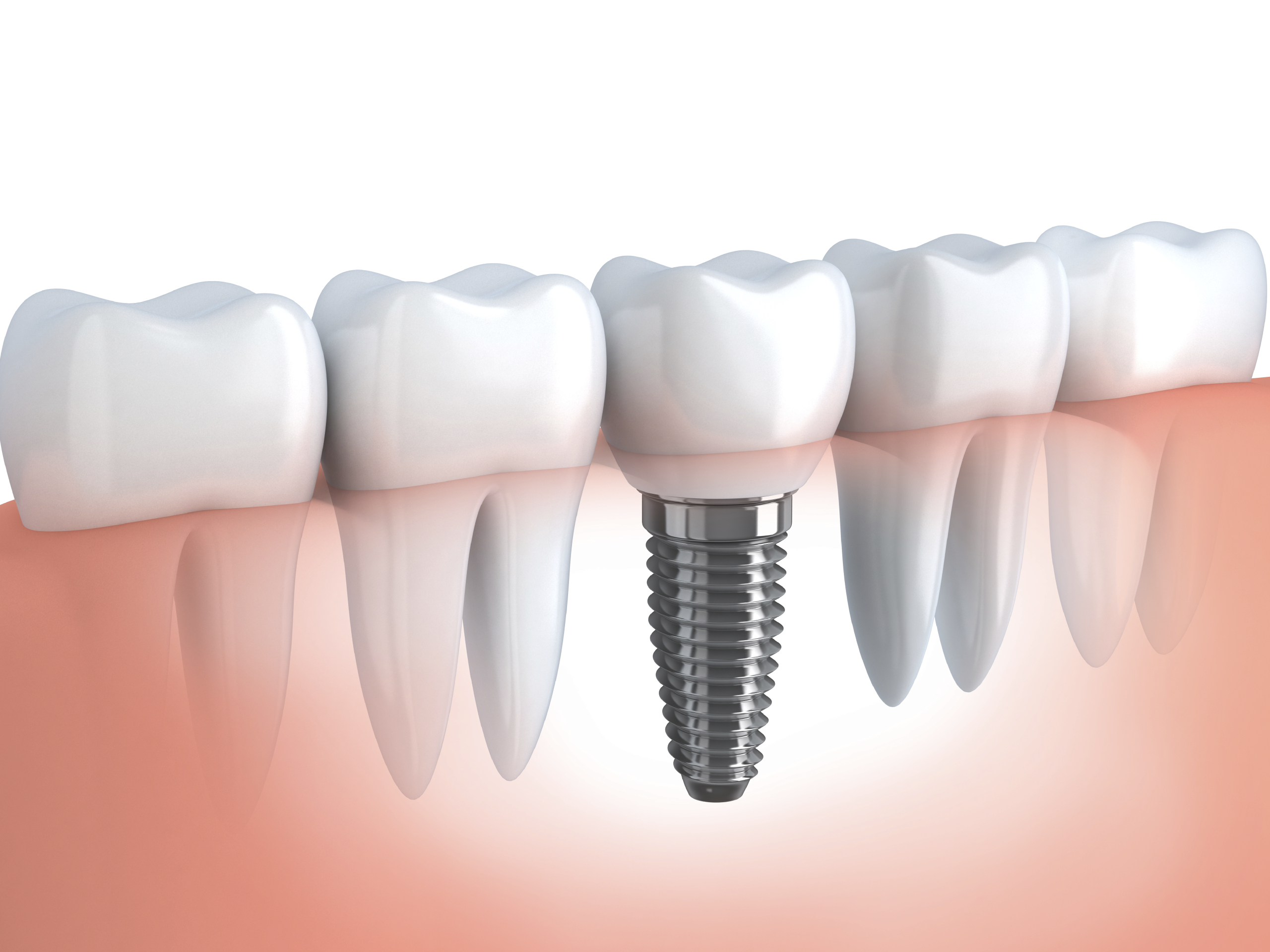 Dental Implant Service