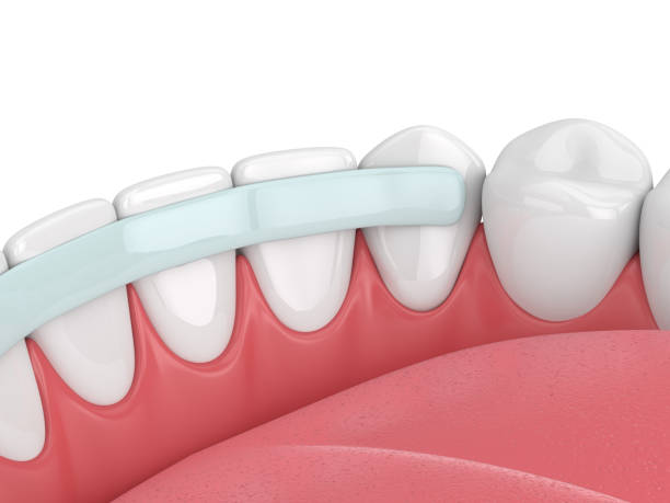 3d render of  teeth with dental reinforcement fiber over white