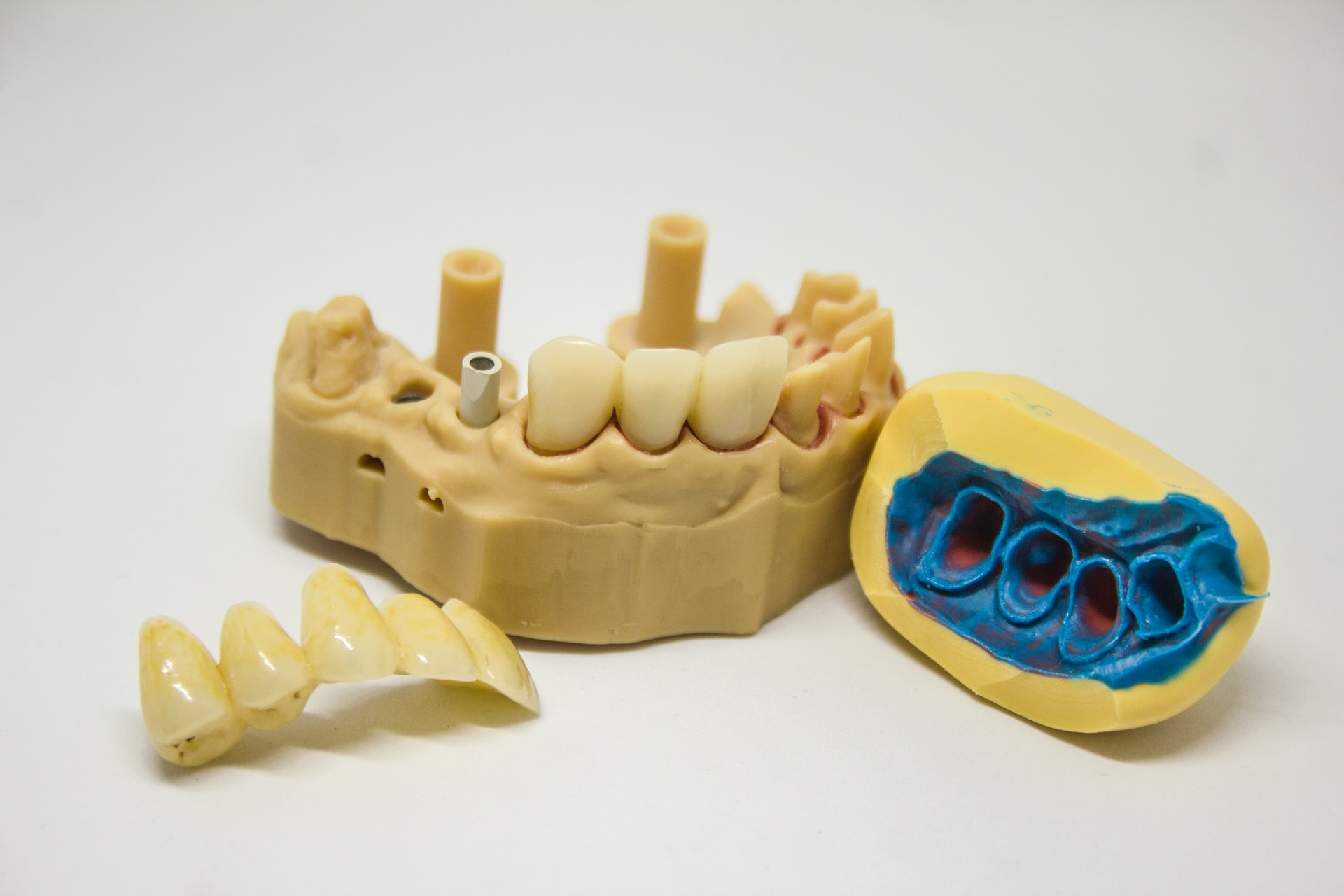 tooth extraction