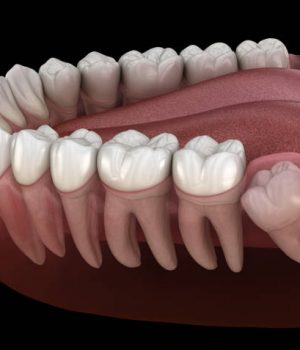 Partial Denture Removable